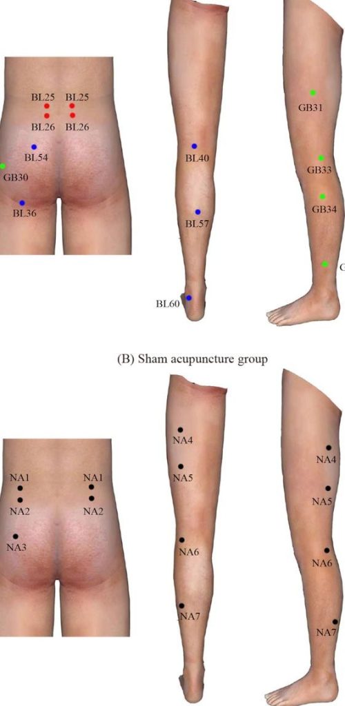 Heng Siao Beng Acupuncture 1 heng siao beng acupuncture